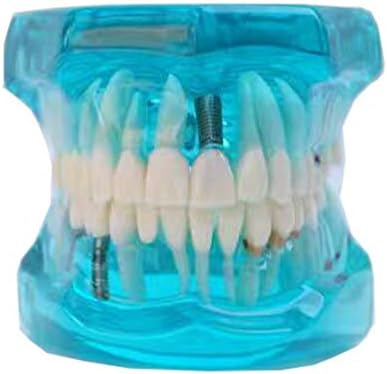 Diş Okulu Öğretimi için İmplantlı TJIRIS Takma Diş Modelleri Restorasyonu